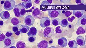 Multiple Myeloma Patients Display Weakened Antibody Responses to mRNA COVID Vaccines